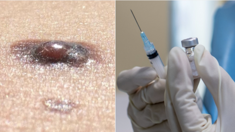 Argentina crea y patenta una vacuna contra el cáncer de piel más agresivo