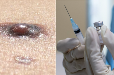 Argentina crea y patenta una vacuna contra el cáncer de piel más agresivo